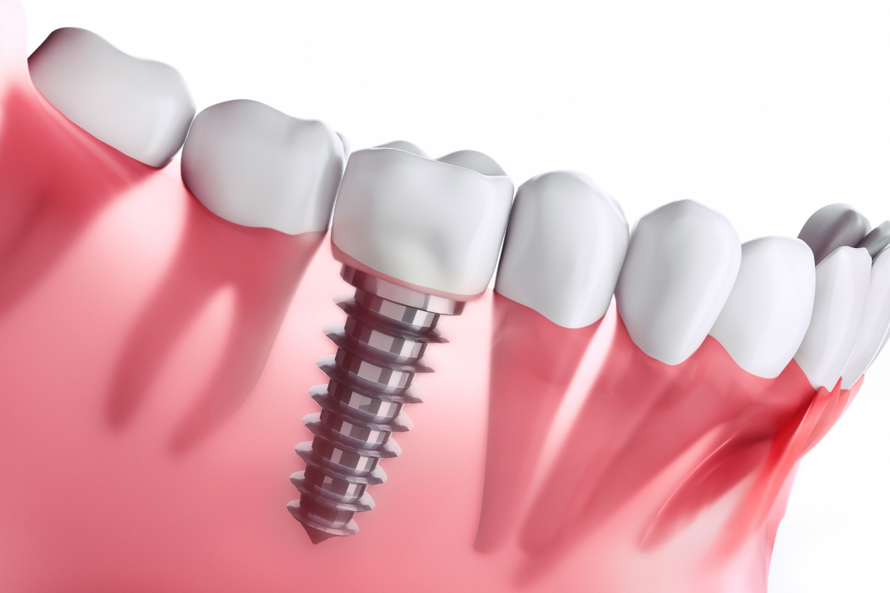 Dental implants icon